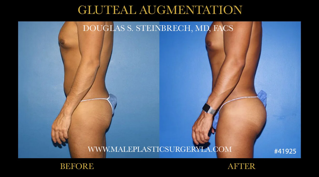 Gluteal Buttock Implants - Before & After Photos