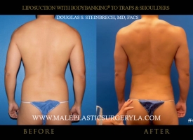 Liposuction - Before & After Photos