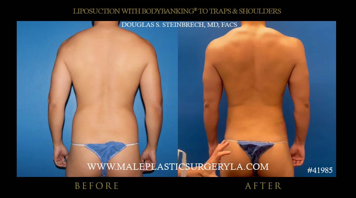 Liposuction - Before & After Photos