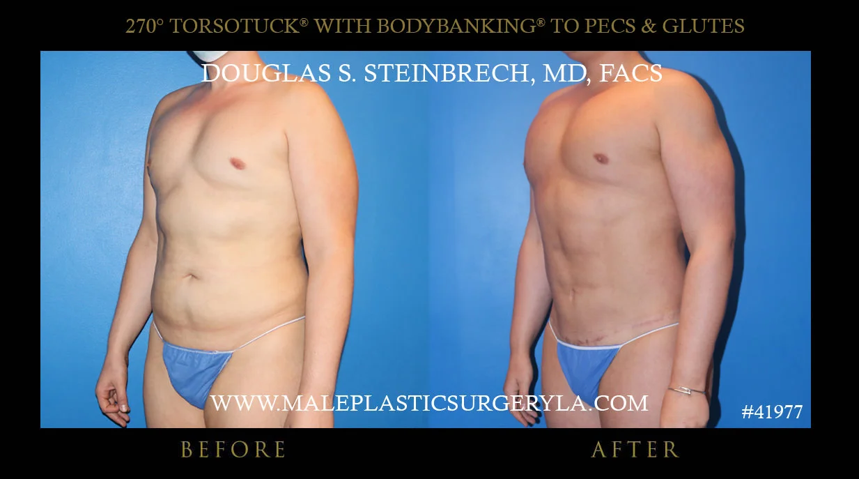 Torsotuck - Before & After Photos