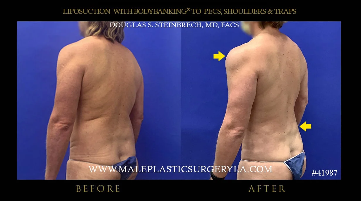 Liposuction - Before & After Photos