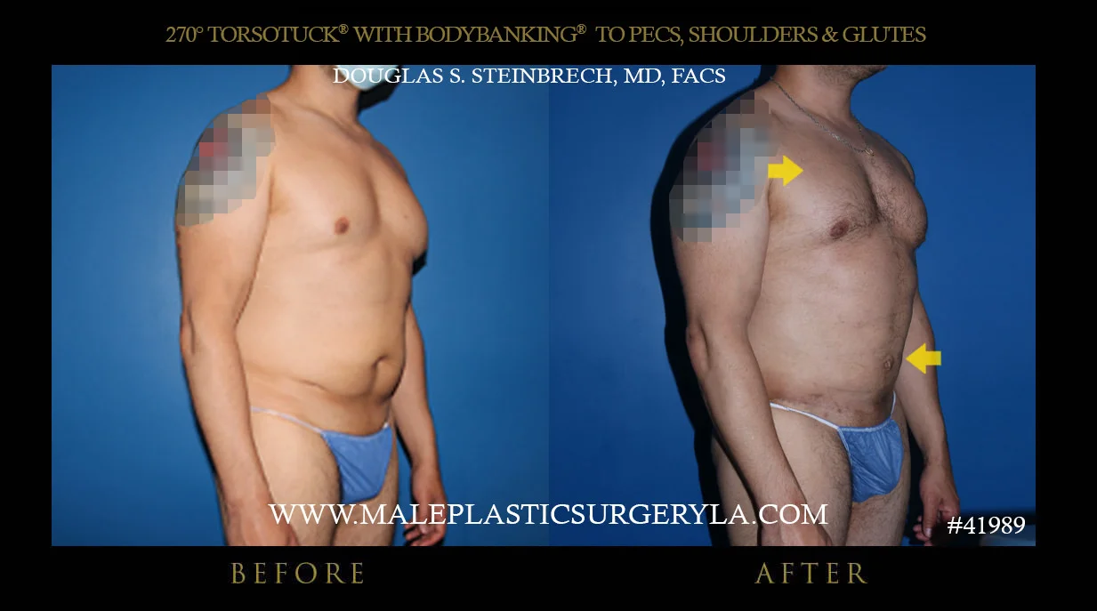 Torsotuck - Before & After Photos