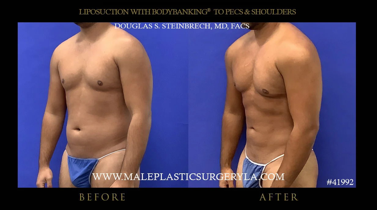 Liposuction - Before & After Photos