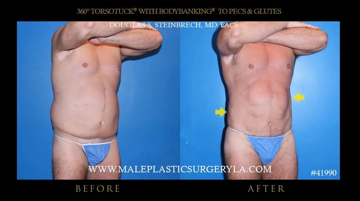 Torsotuck - Before & After Photos