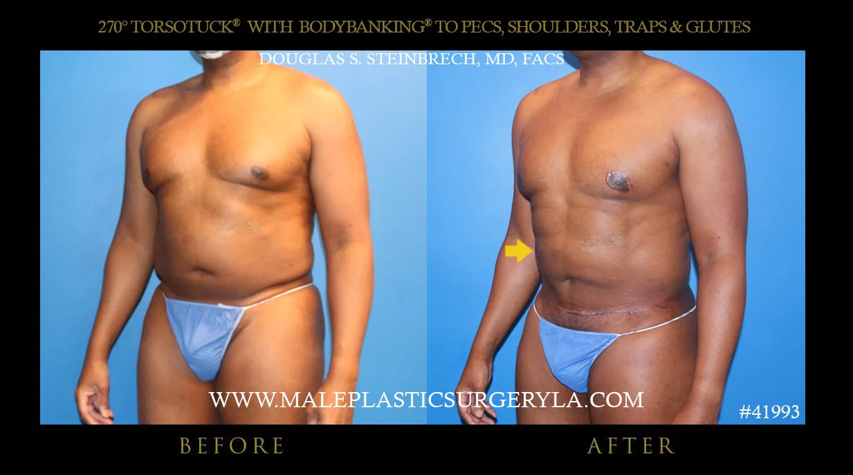 Torsotuck - Before & After Photos