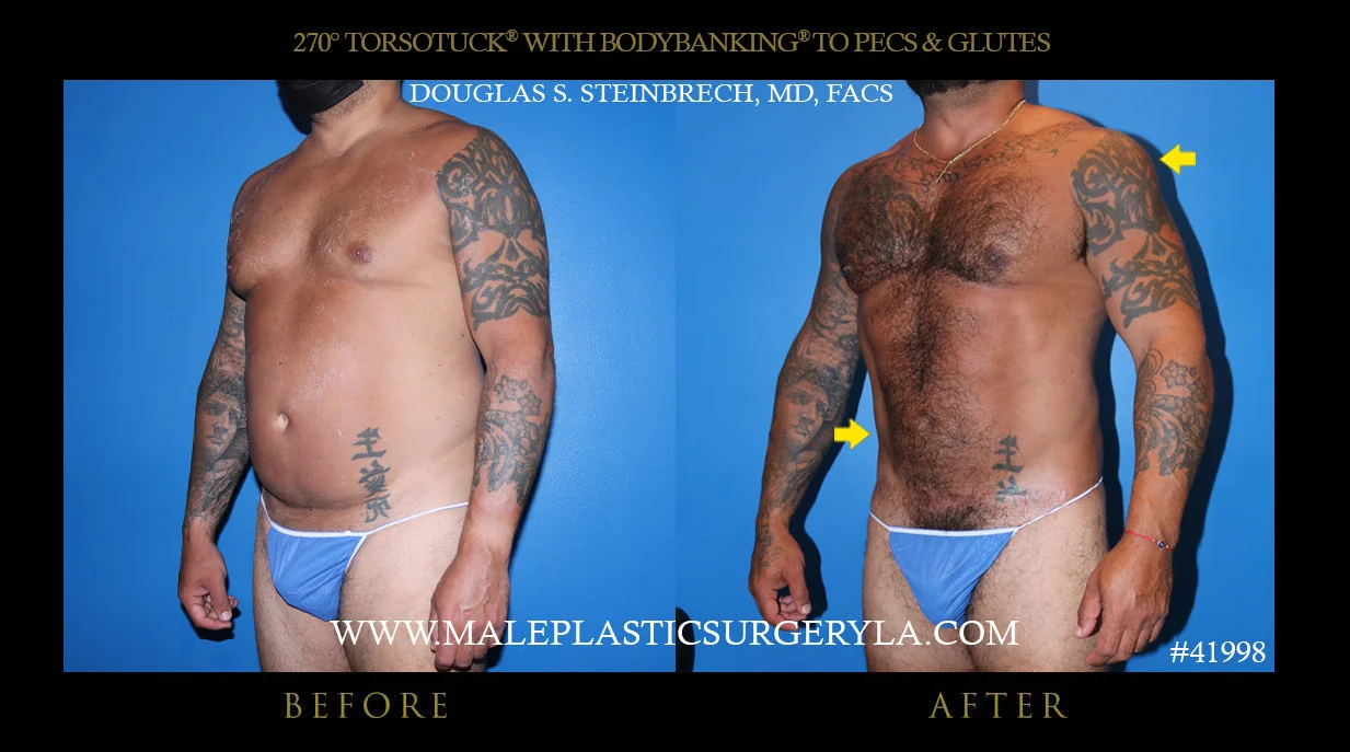 Torsotuck - Before & After Photos