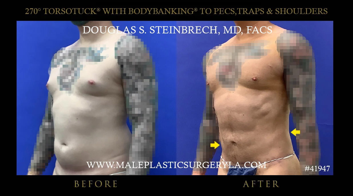 Torsotuck - Before & After Photos