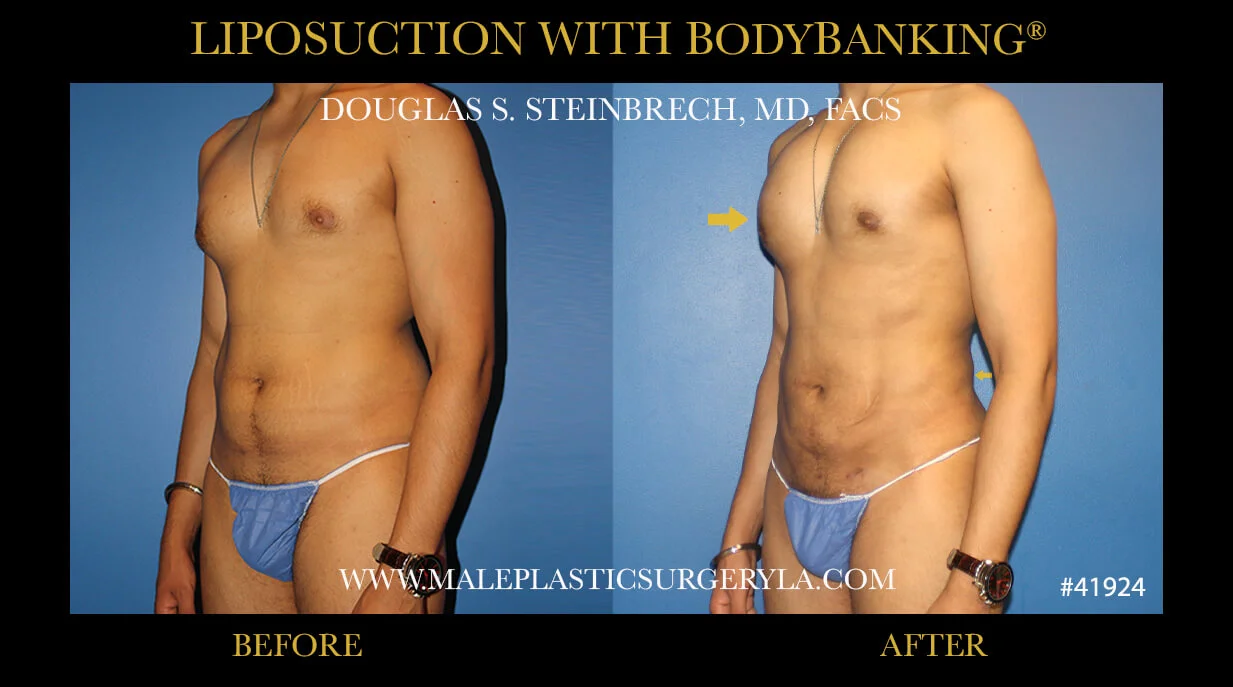 Liposuction - Before & After Photos