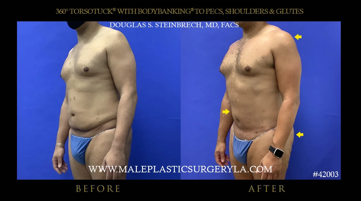 Torsotuck - Before & After Photos