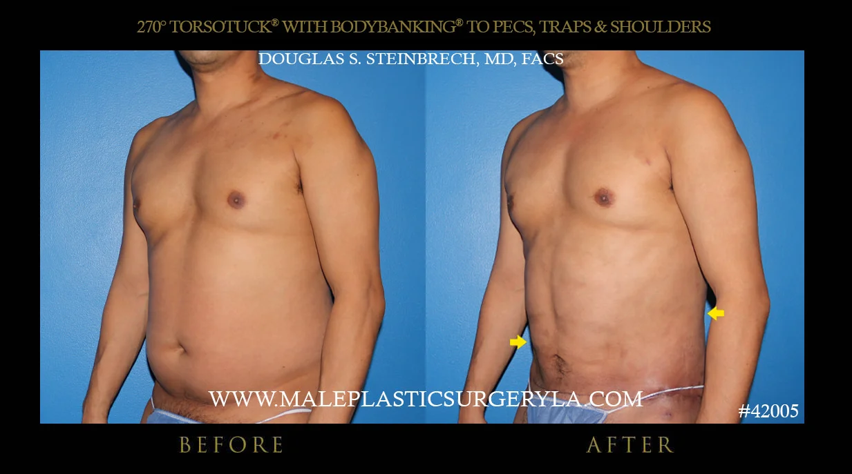 Torsotuck - Before & After Photos