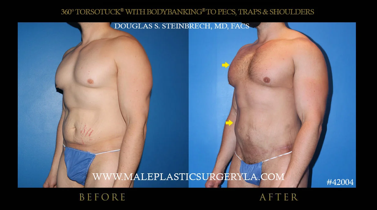 Torsotuck - Before & After Photos