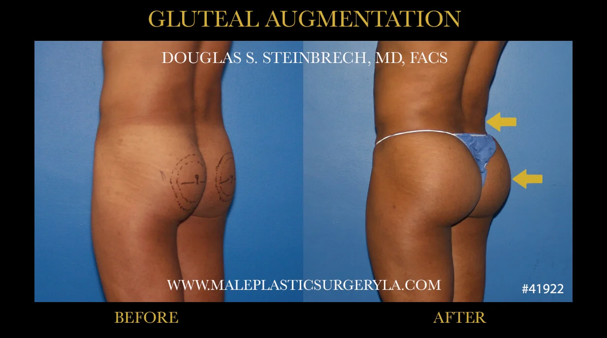 Gluteal Buttock Implants - Before & After Photos