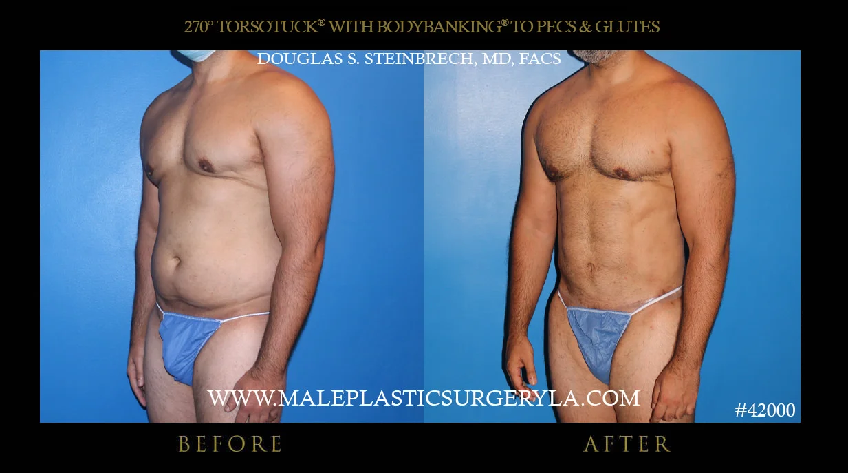 Torsotuck - Before & After Photos