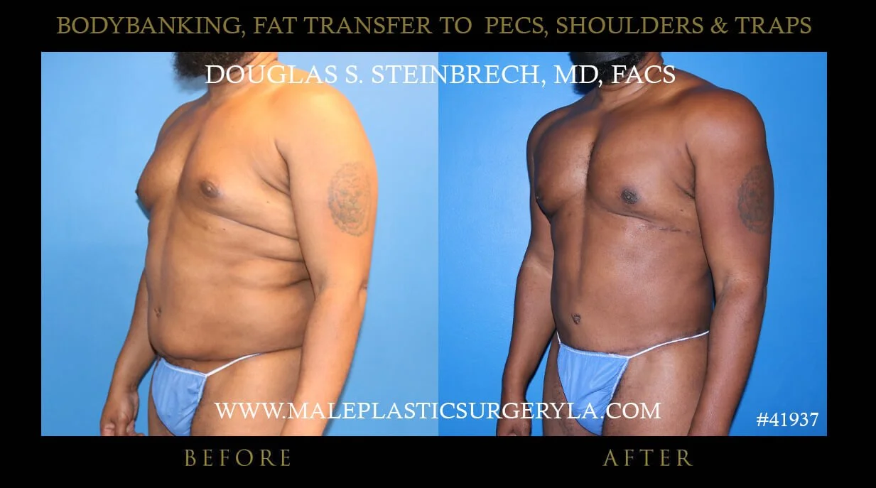 Liposuction - Before & After Photos