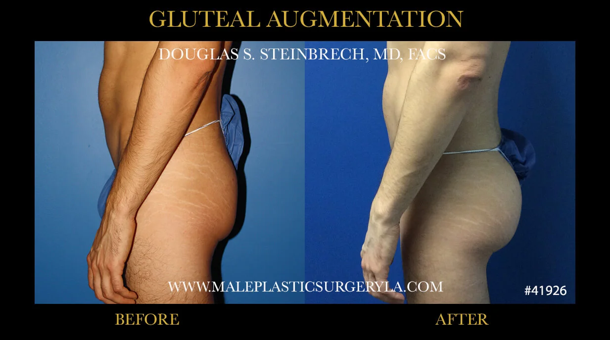 Gluteal Buttock Implants - Before & After Photos