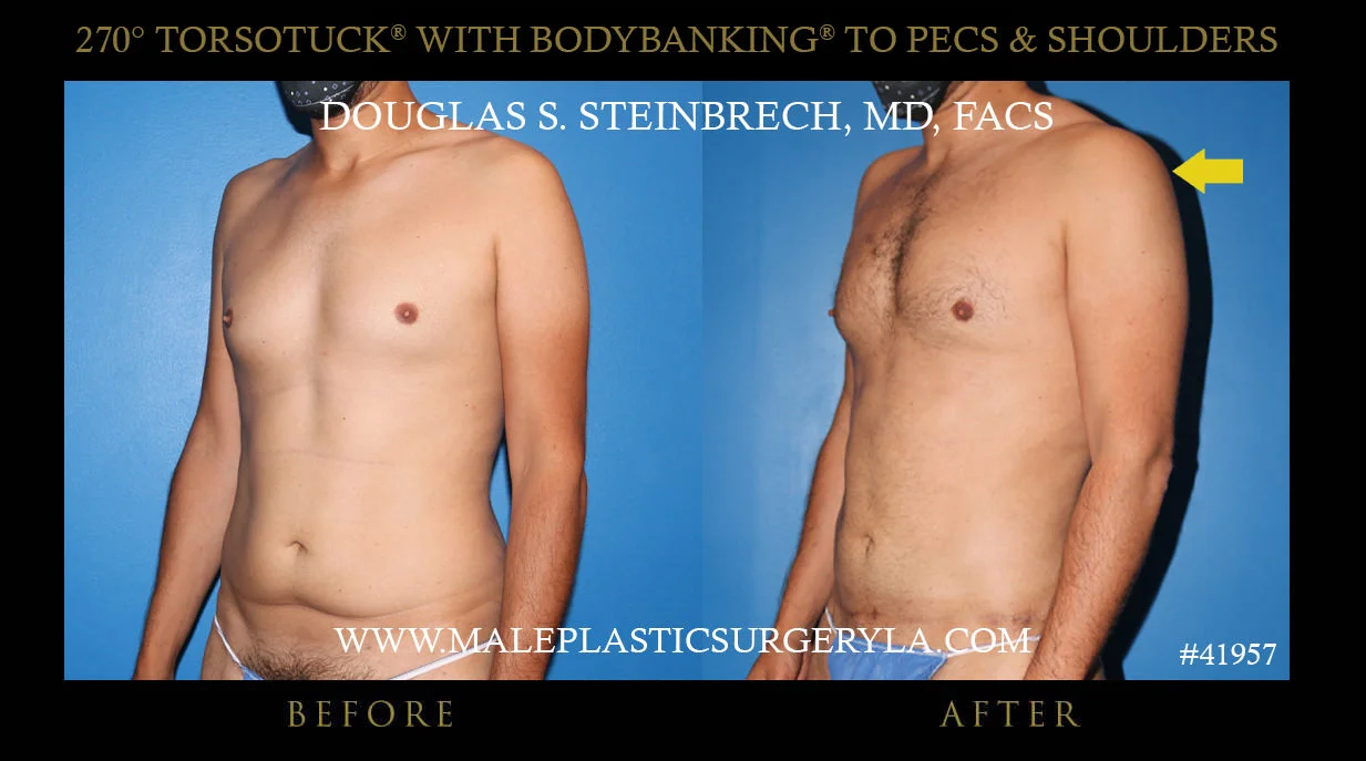 Torsotuck - Before & After Photos