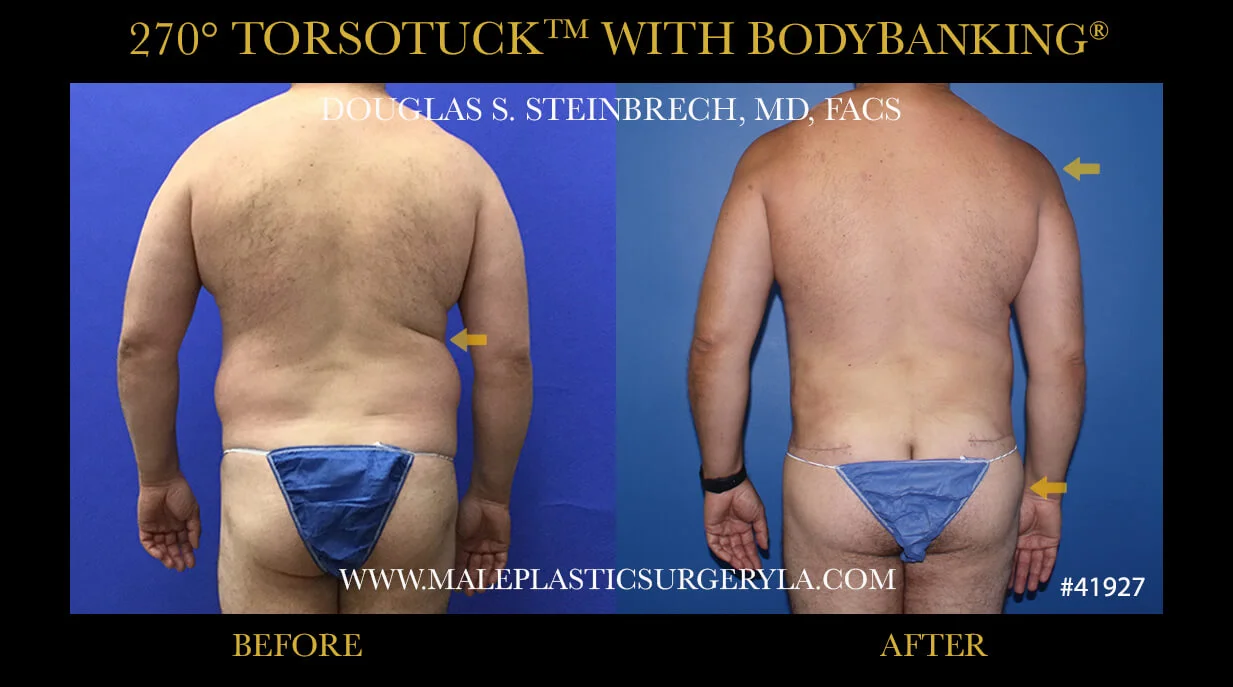 Torsotuck - Before & After Photos