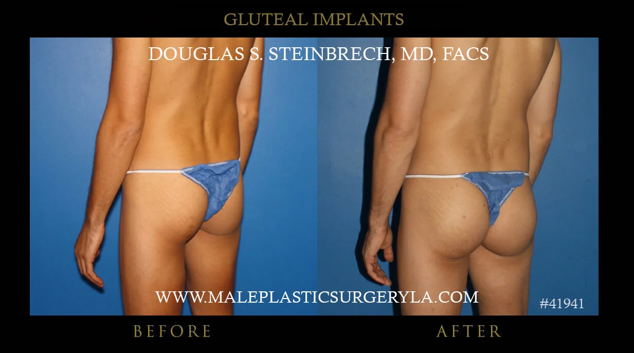 Gluteal Buttock Implants - Before & After Photos