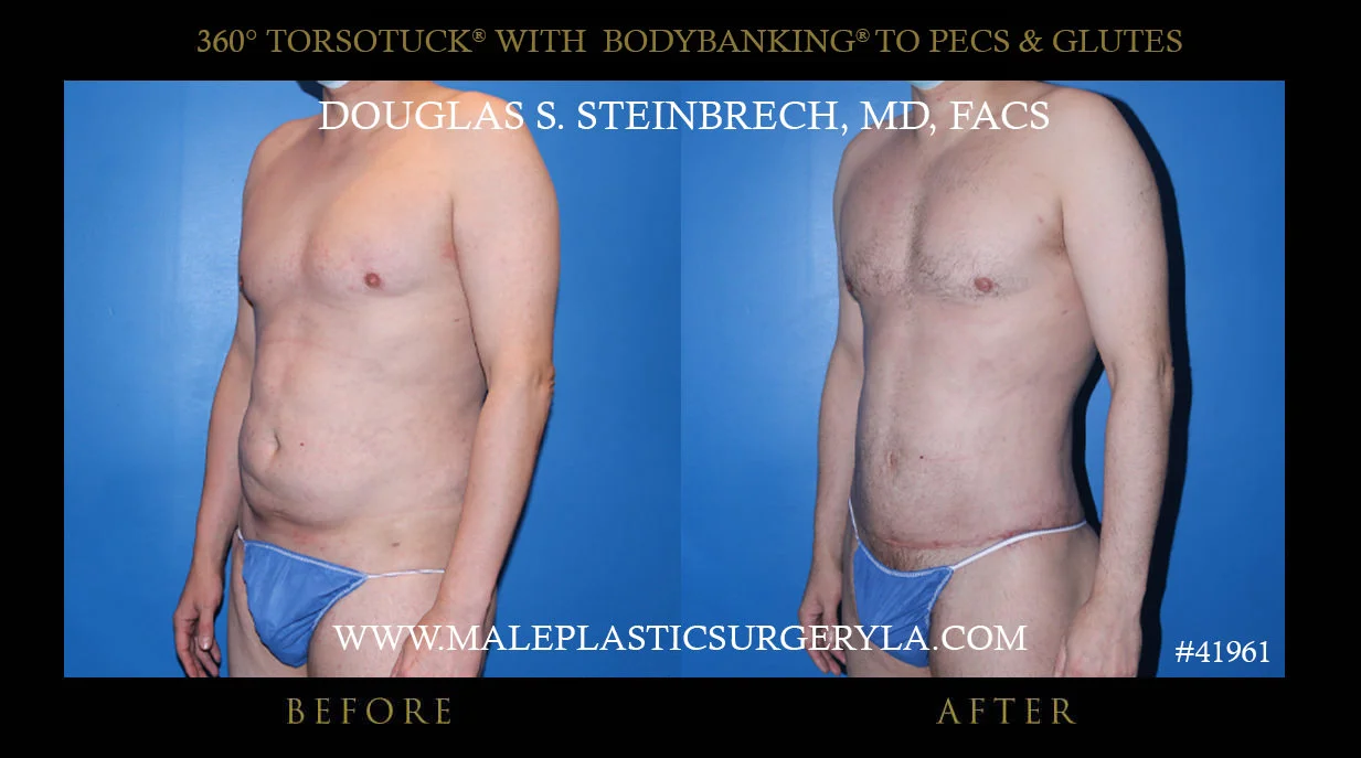 Torsotuck - Before & After Photos