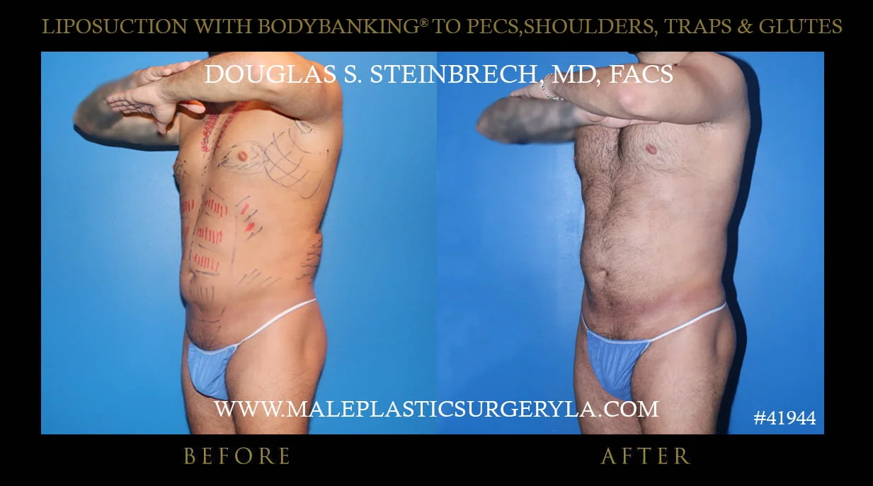 Liposuction - Before & After Photos