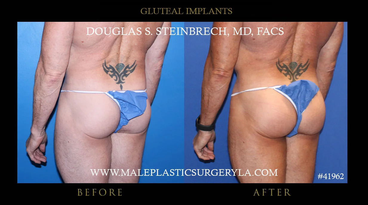 Gluteal Buttock Implants - Before & After Photos