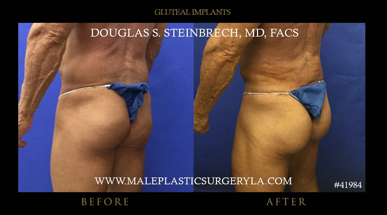 Gluteal Buttock Implants - Before & After Photos