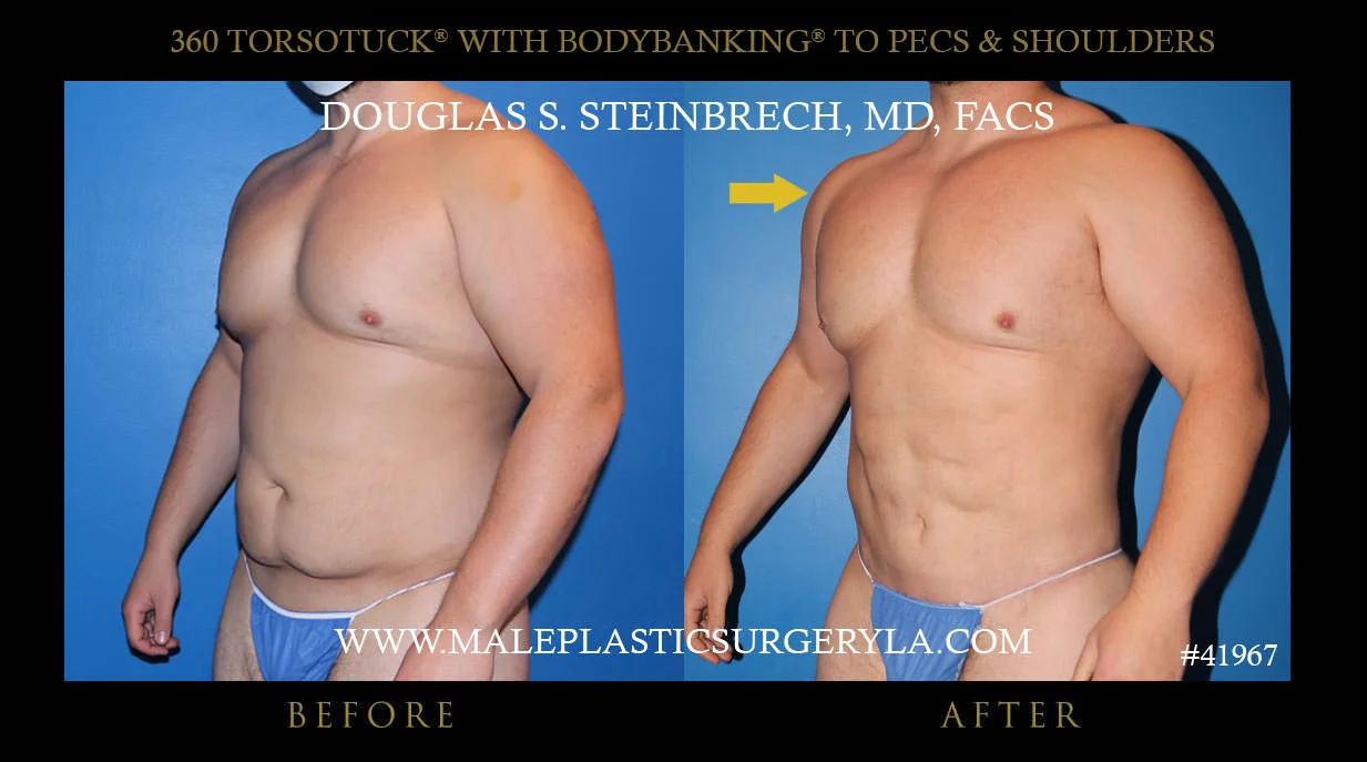 Torsotuck - Before & After Photos