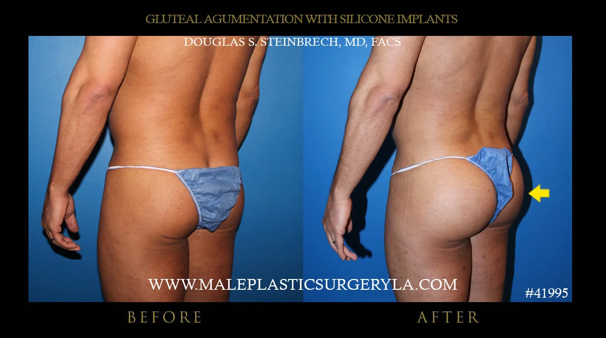 Gluteal Buttock Implants - Before & After Photos