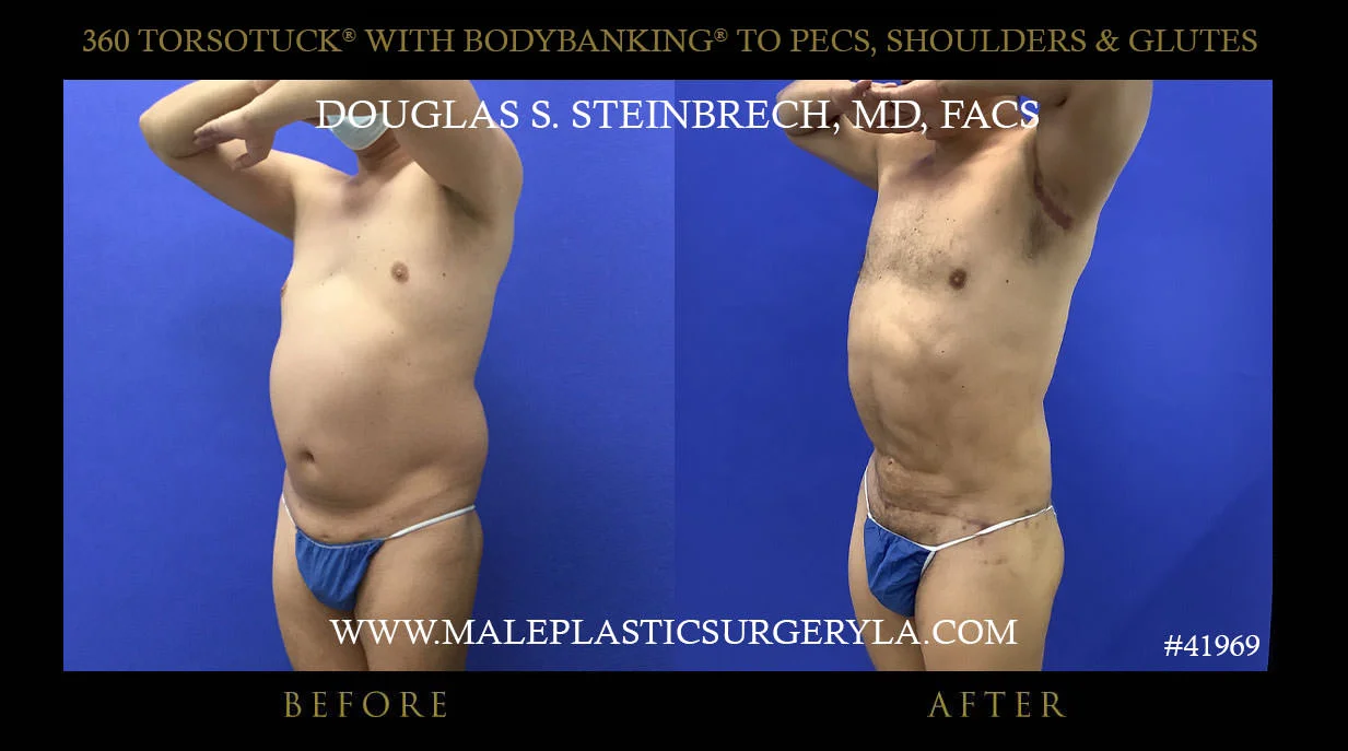 Torsotuck - Before & After Photos