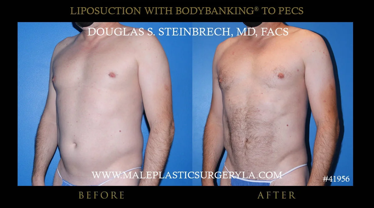 Liposuction - Before & After Photos