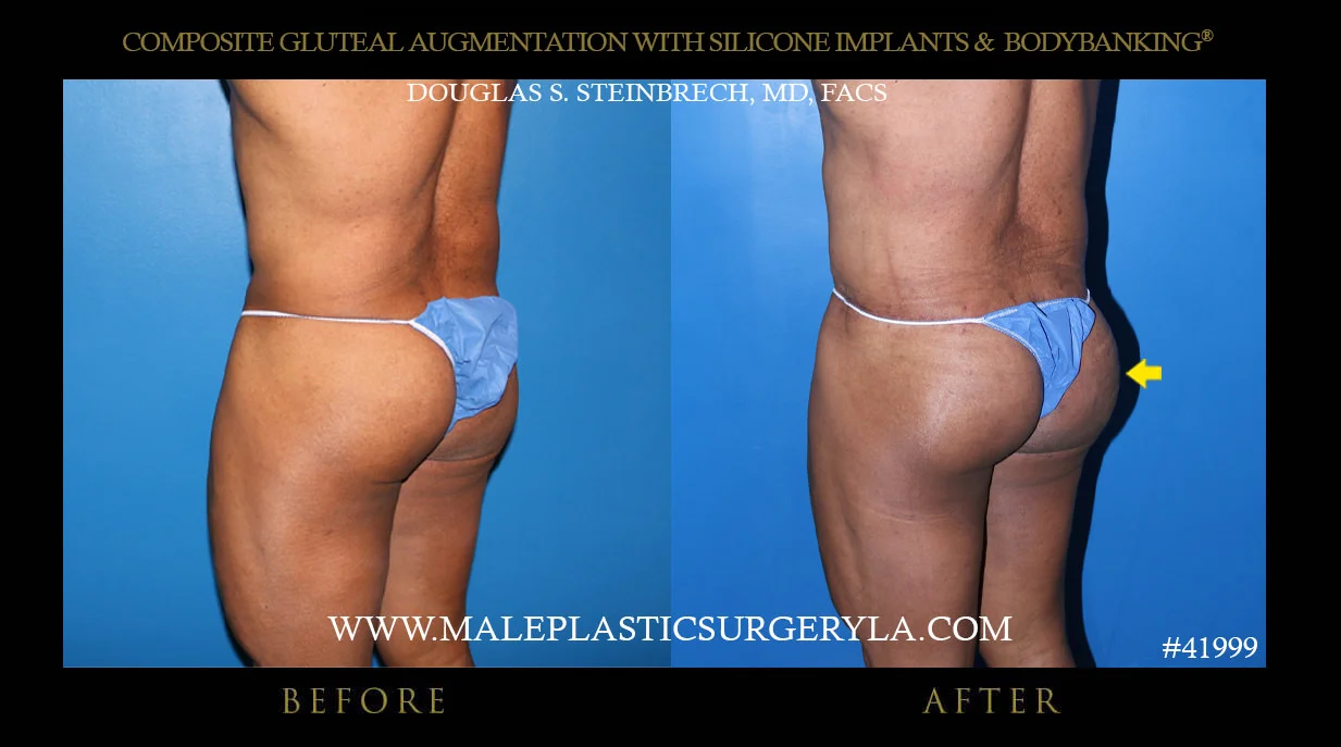 Gluteal Buttock Implants - Before & After Photos