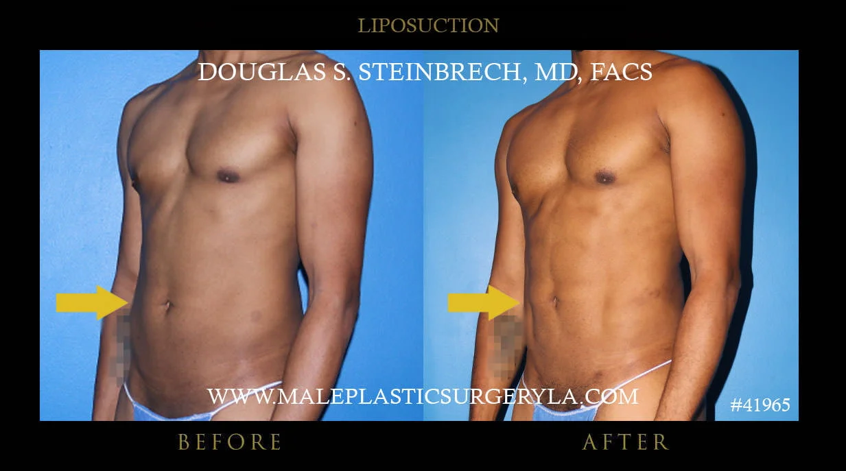 Liposuction - Before & After Photos