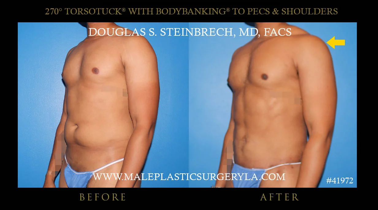 Torsotuck - Before & After Photos