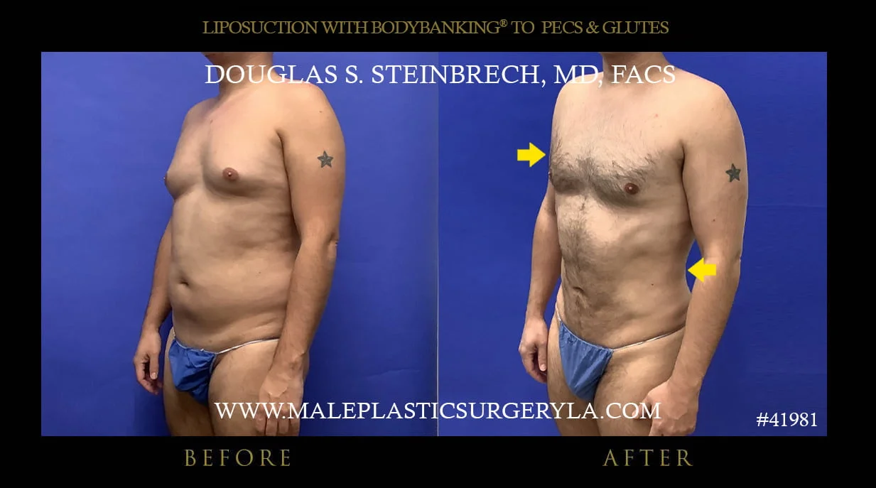 Liposuction - Before & After Photos