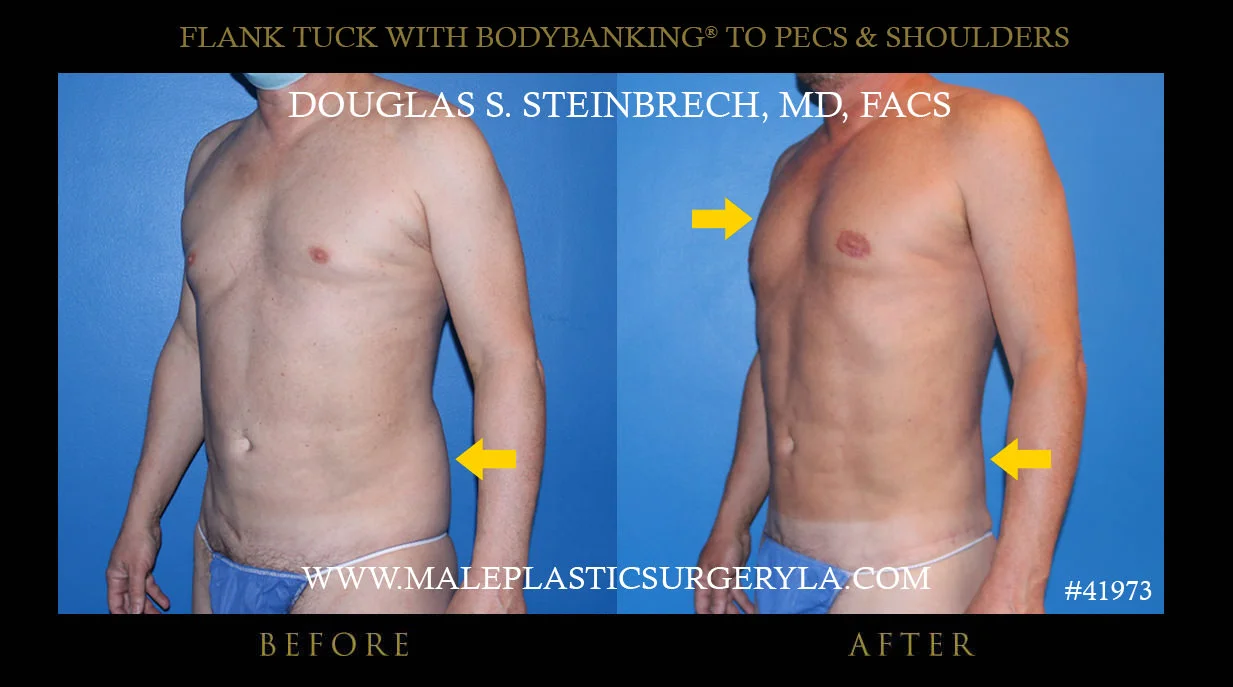 Torsotuck - Before & After Photos