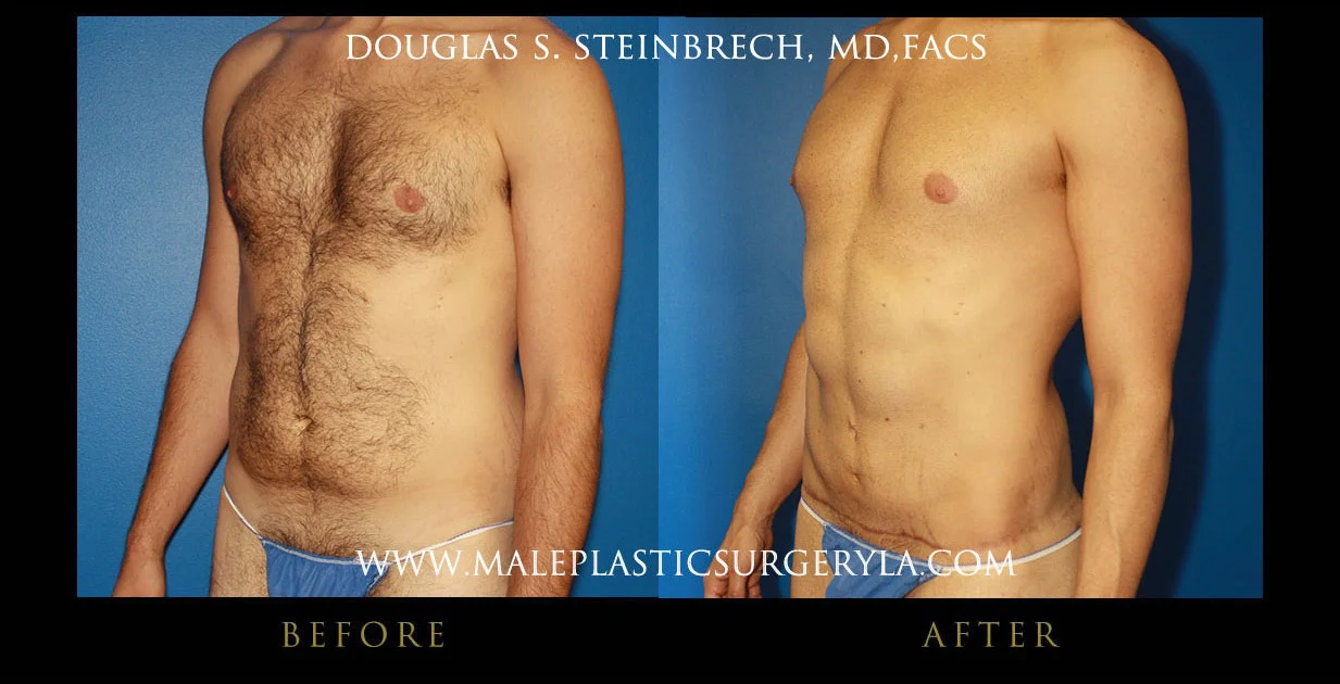 Torsotuck - Before & After Photos