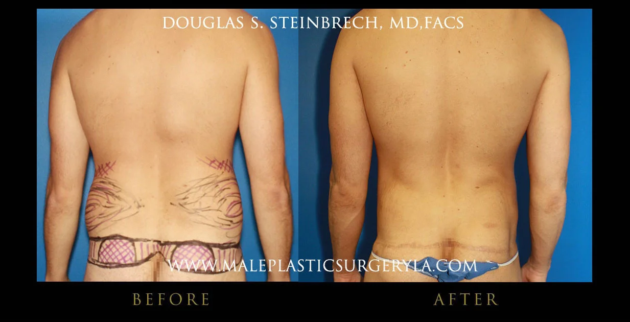 Torsotuck - Before & After Photos