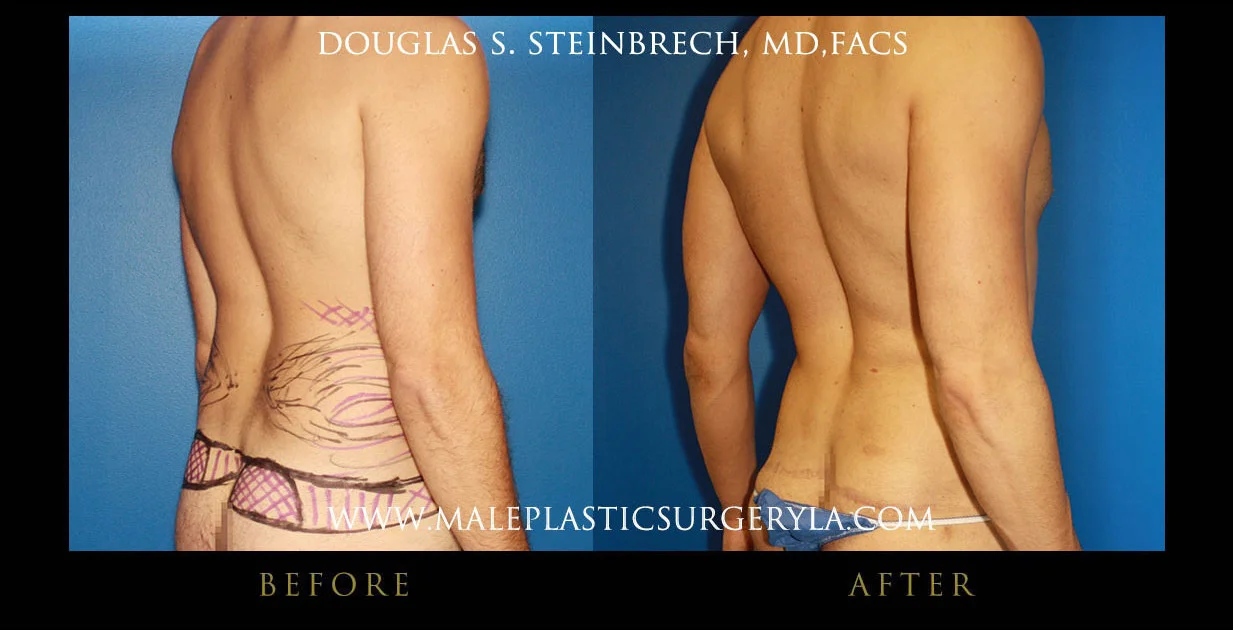 Torsotuck - Before & After Photos