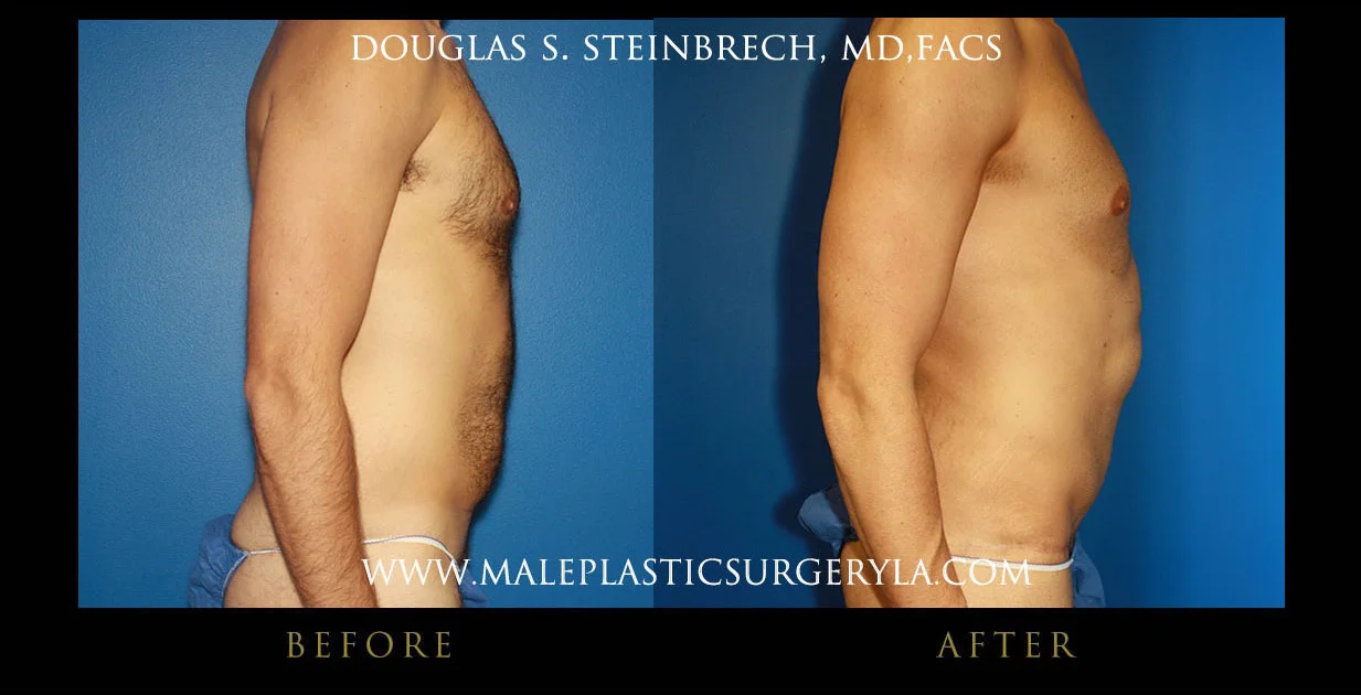 Torsotuck - Before & After Photos