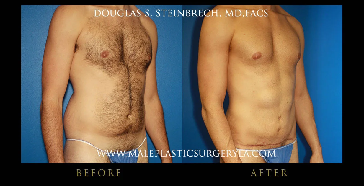 Torsotuck - Before & After Photos