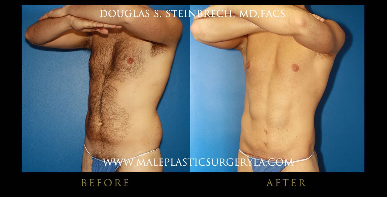 Torsotuck - Before & After Photos