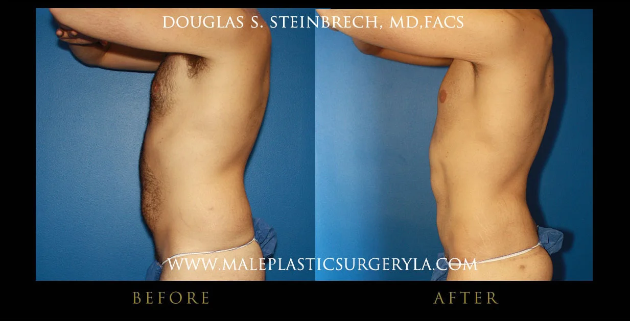 Torsotuck - Before & After Photos