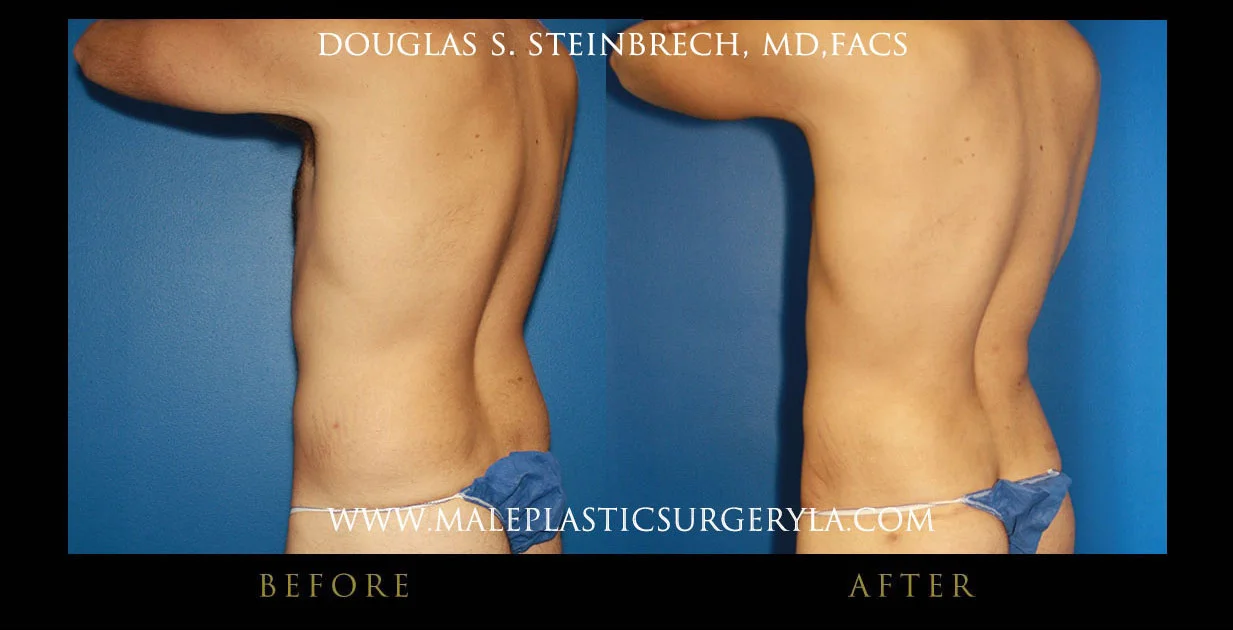 Torsotuck - Before & After Photos