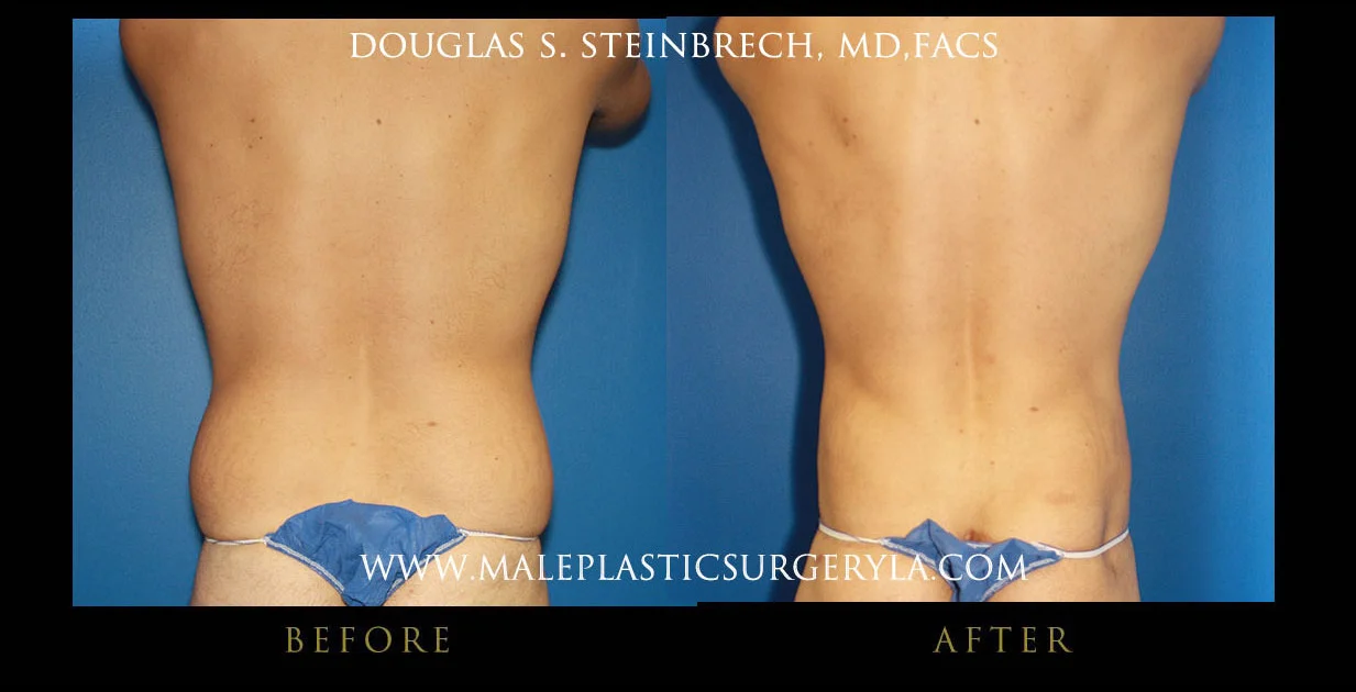 Torsotuck - Before & After Photos