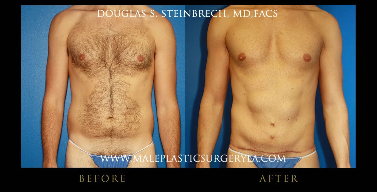 Torsotuck - Before & After Photos