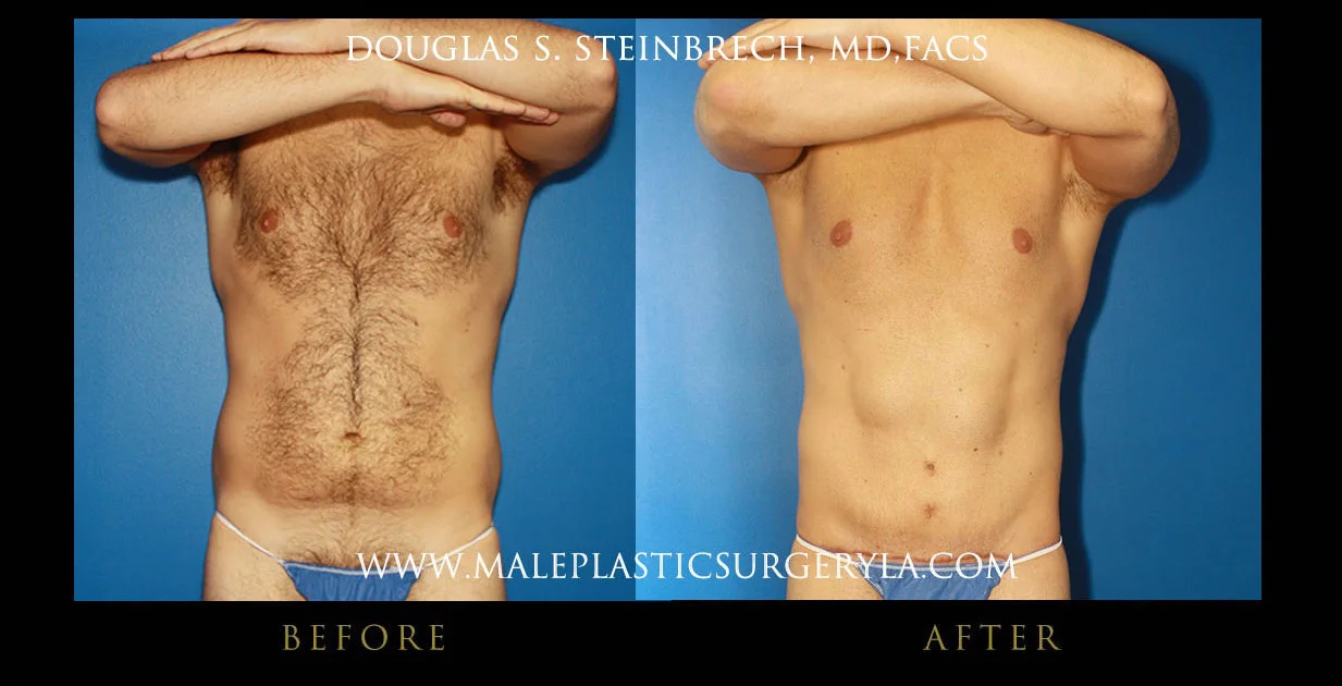 Torsotuck - Before & After Photos