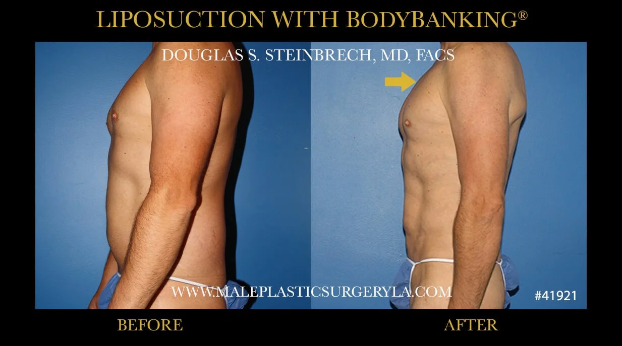 Liposuction - Before & After Photos