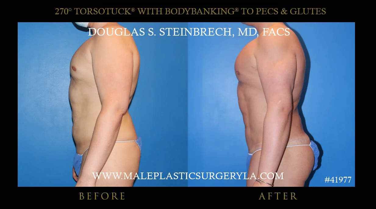 Torsotuck - Before & After Photos