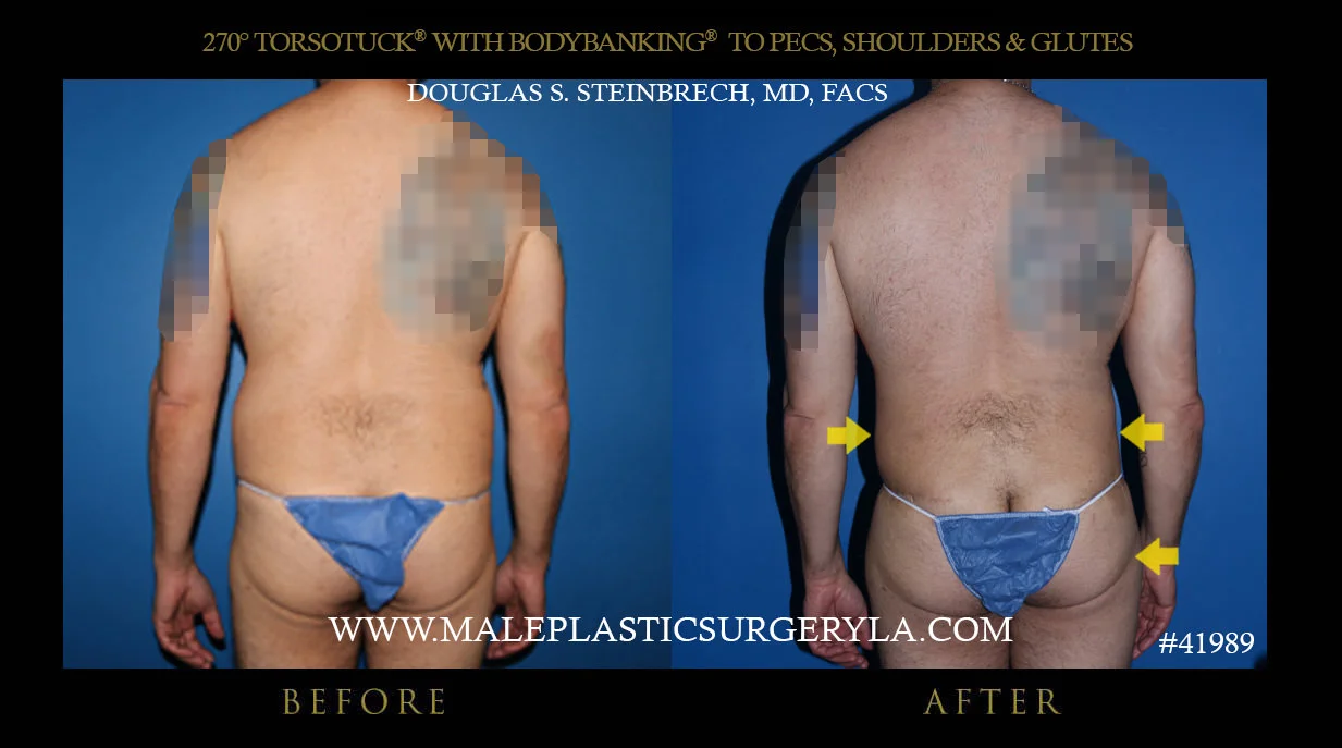 Torsotuck - Before & After Photos