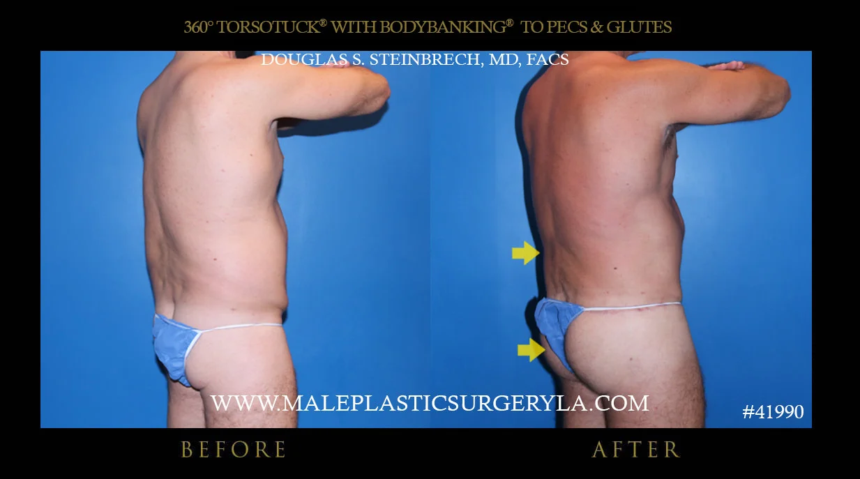 Torsotuck - Before & After Photos